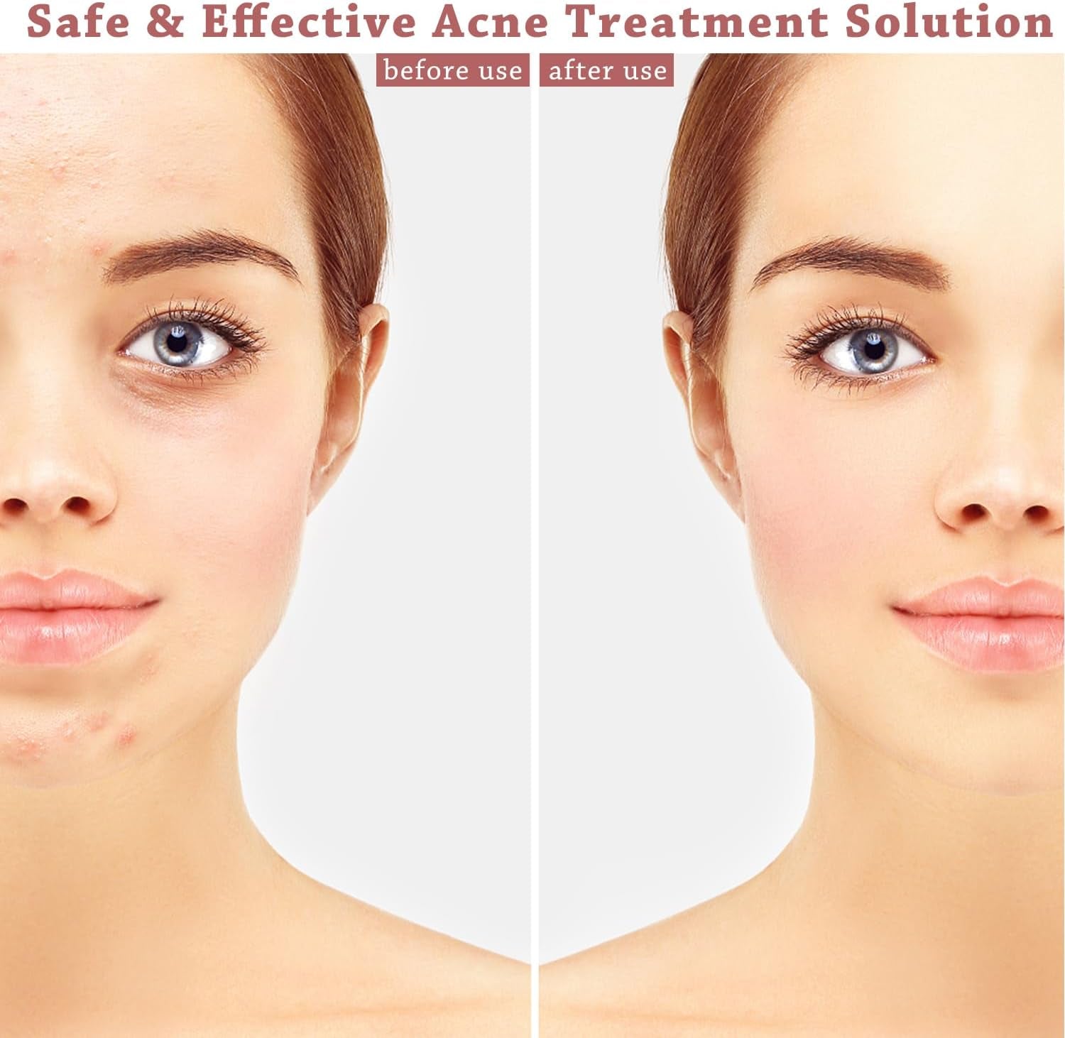 720 Pcs Hydrocolloid Acne Patches for Day & Night Use - Invisible Blemish Stickers for Spot Treatment, Clear Pimple Dots for Face Care (20 Sheets, Gentle & Effective)